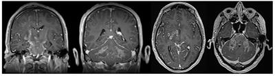 Case report: First case of neuromelioidosis in Europe: CNS infection caused by Burkholderia pseudomallei